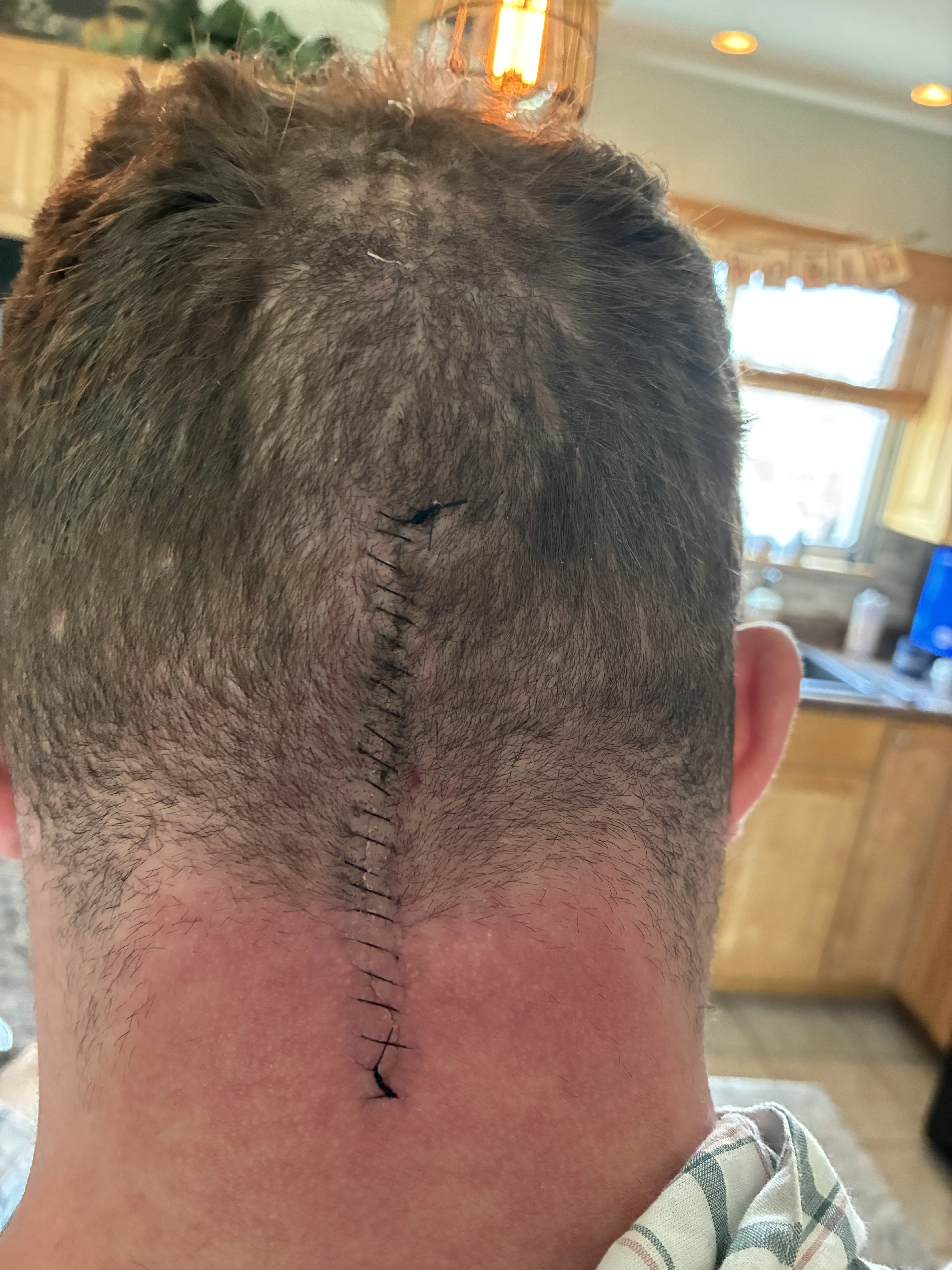 Joe's surgical scar at the base of the skull — Day 15 post-op